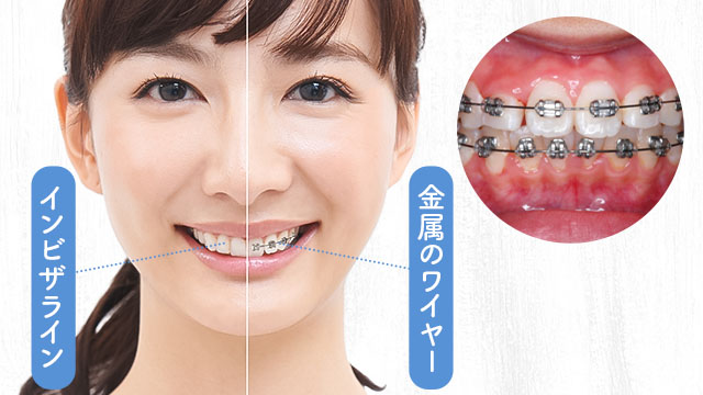 インビザライン・ワイヤー矯正