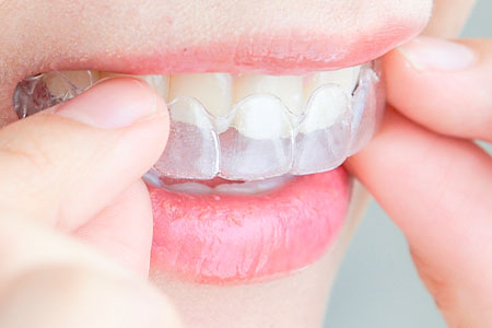 マウスピース矯正