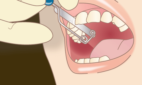 八重歯 乱ぐい歯 でお悩みの方 矯正でキレイに治ります